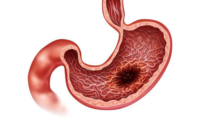 Sanidad Canaria Estos Son Los Síntomas Del Cáncer De Estómago Con Los Que Puedes Detectar La 2124